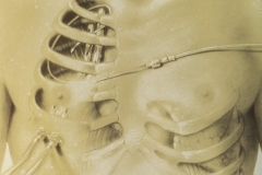 Thoracostomy - Medical Journal